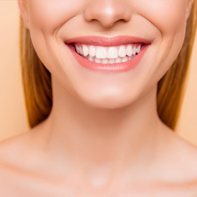 teeth whitening marble hill ga