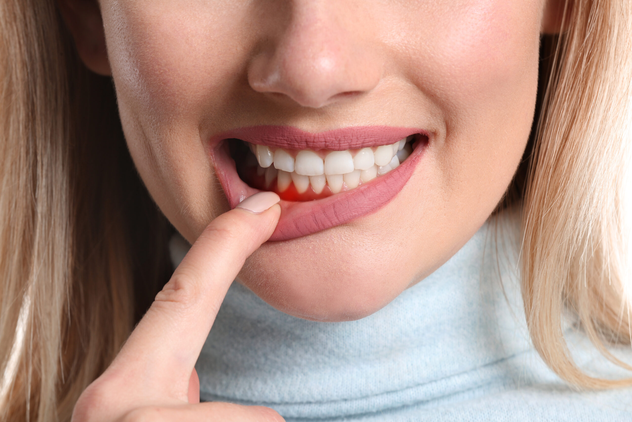 Clear Aligners for Adults in Marble Hill, GA: Discreetly Perfect Your Smile