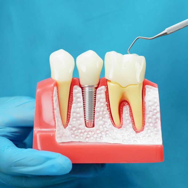 Dental implants marble hill