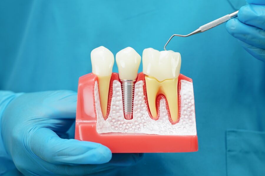 Dental implants marble hill